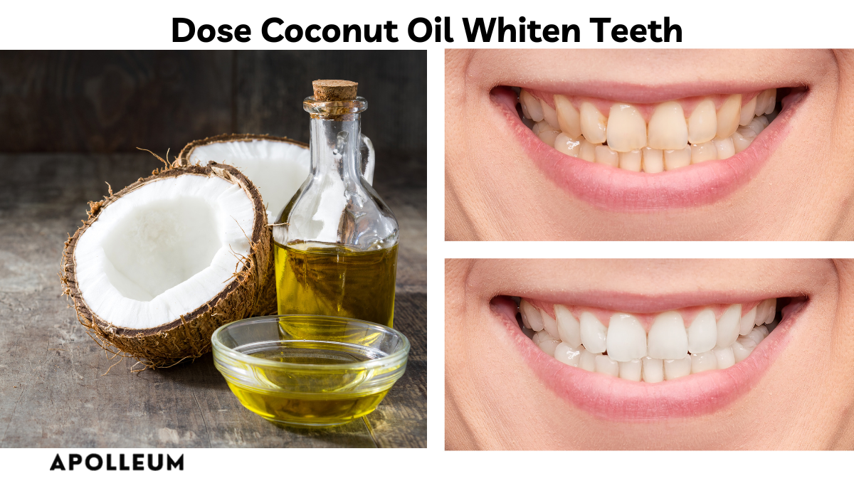 Dose Coconut Oil Whiten Teeth